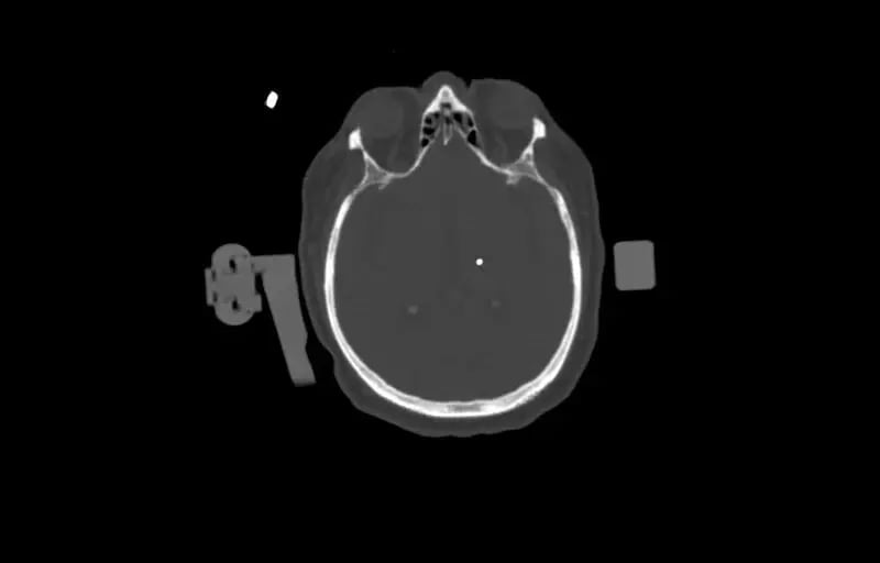 1.25mm-Deep-Brain-Stimulation -Bone-Window-1 Electrode-3