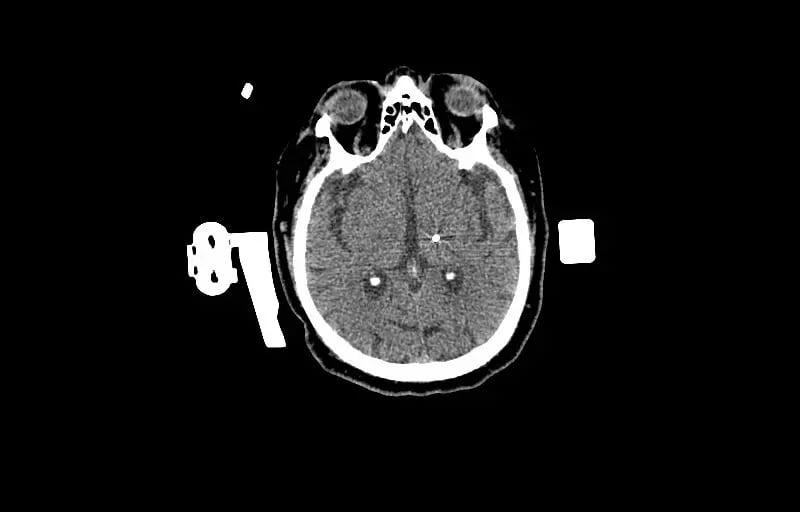 1.25mm-Deep-Brain-Stimulation -Bone-Window-1 Electrodes-3
