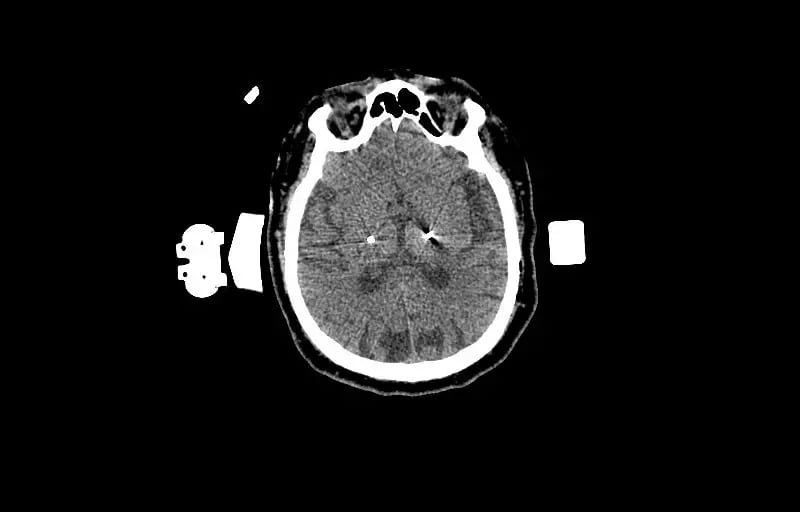1.25mm-Deep-Brain-Stimulation -Bone-Window-2 Electrodes-2