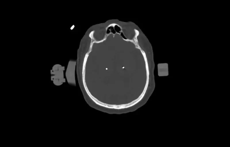1.25mm-Deep-Brain-Stimulation -Bone-Window-2 Electrodes-3