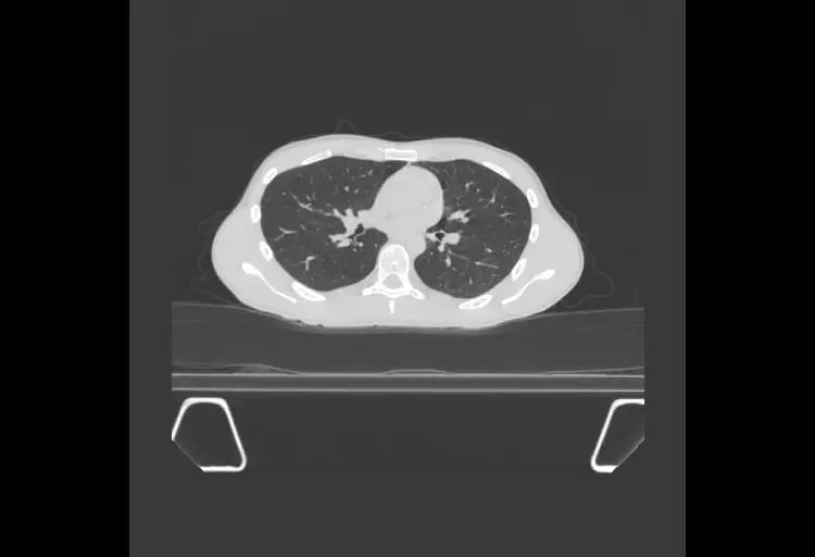BodyTom 64 Lung A 1-1