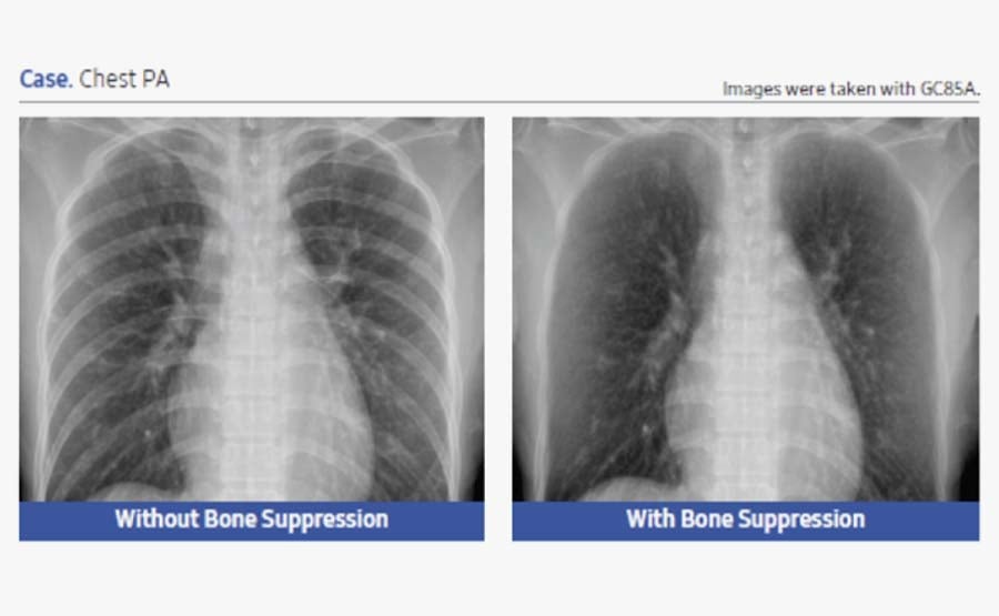 Bone Suppression