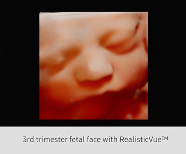3rd trimester fetal face with RealisticVue™