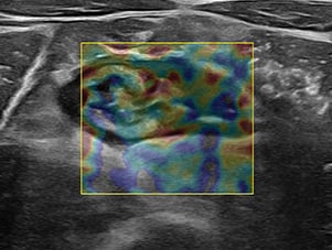 Ascending colon ultrasound image