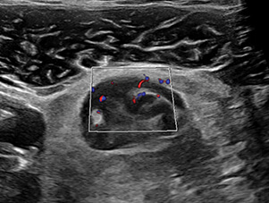 Terminal lleum with Hyperemia ultrasound image