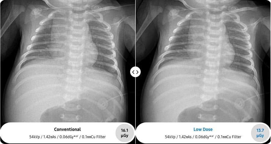 Pediatric Chest PA