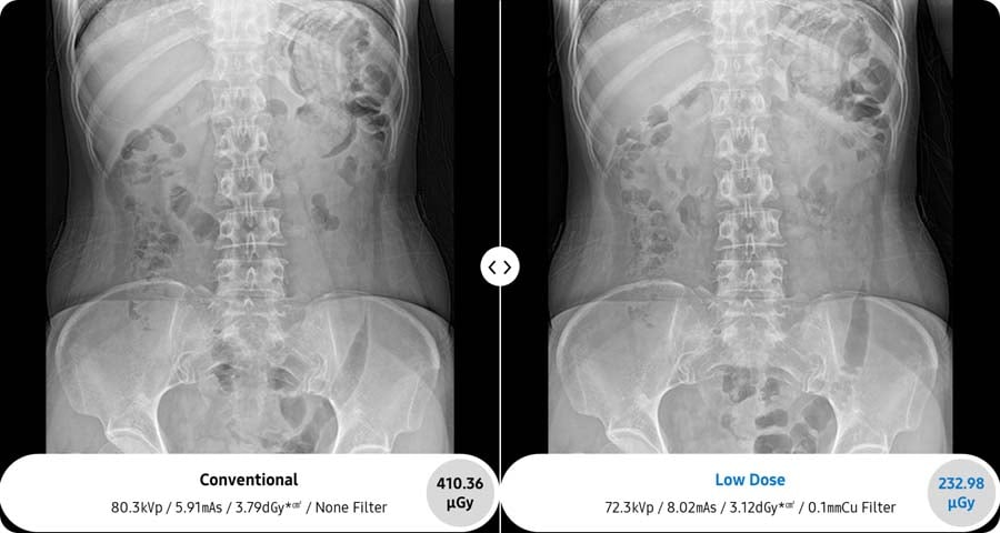 Pediatric Abdomen PA
