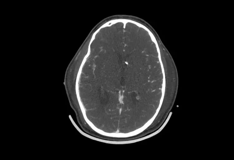 CereTom CTA Axial image