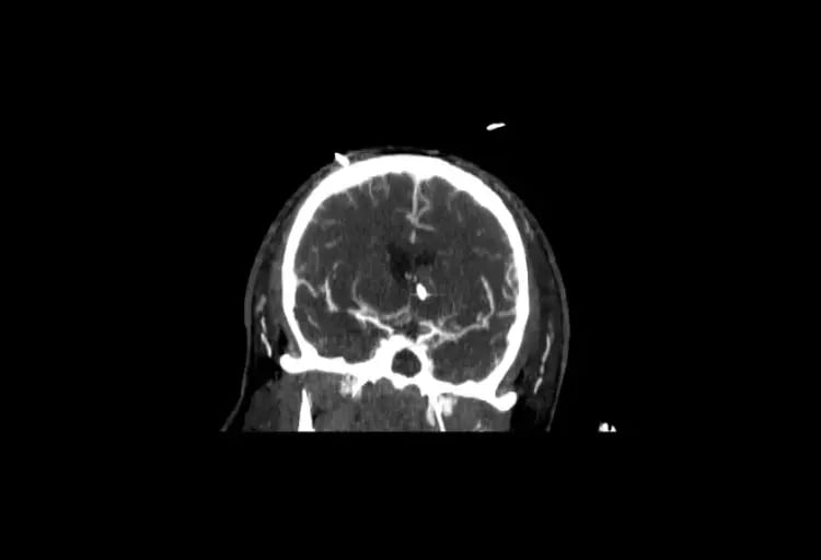CereTom CTA Coronal image-1