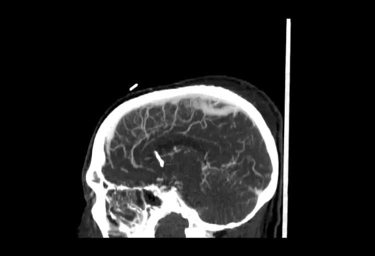 CereTom CTA Sagittal image-1