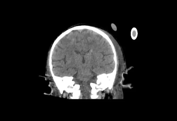 CereTom Pediatric A Coronal Brain-1