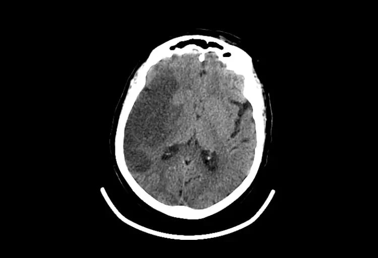 CereTom Stroke A image 3-1