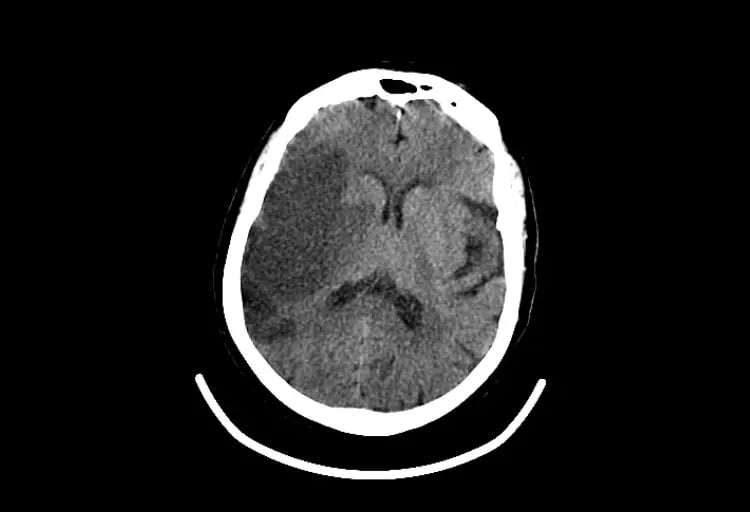 CereTom Stroke A image 4-1