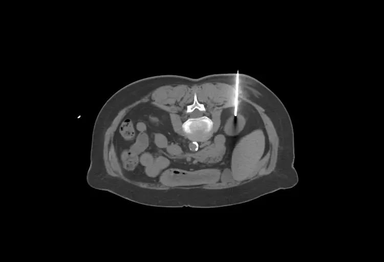 Kidney Biopsy-1