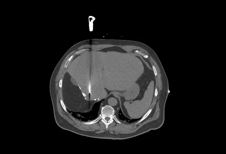 Liver Ablation-1
