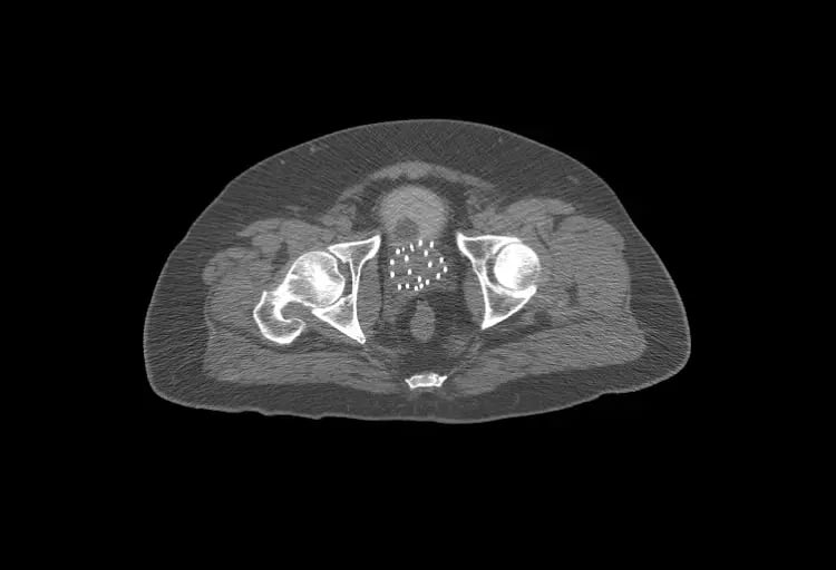 Prostate-12