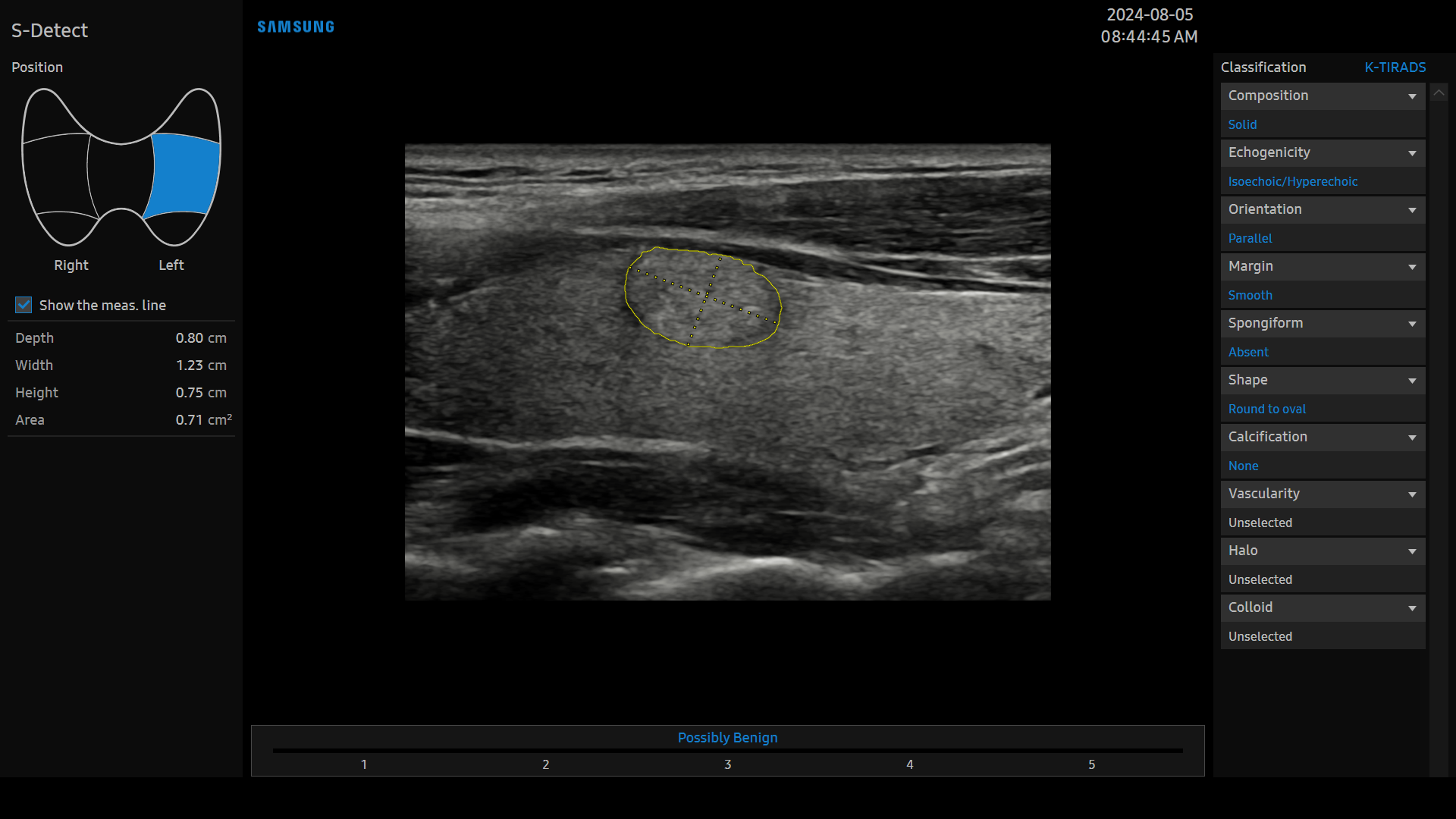 S-Detect for Thyroid