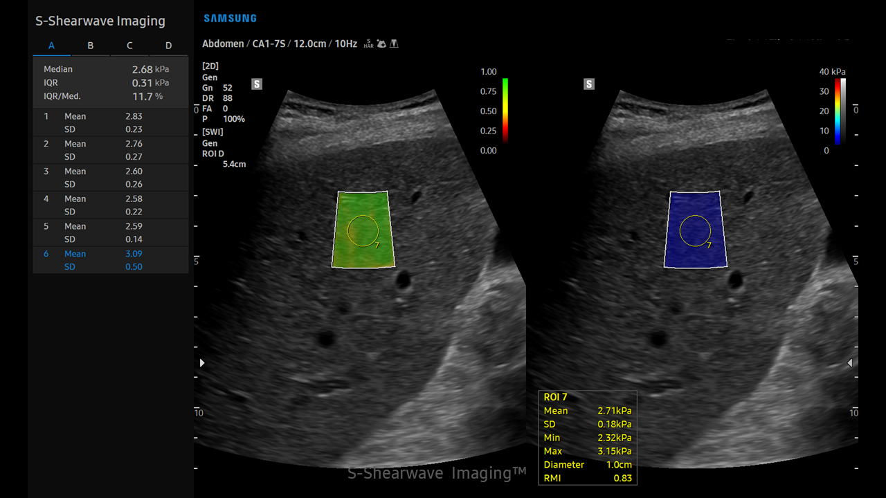 S-Shearwave Imaging