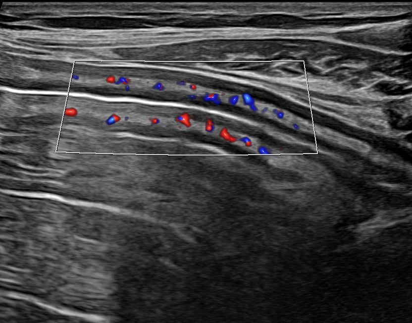 Sigmoid colon BWH Longitudinal 9-6-23