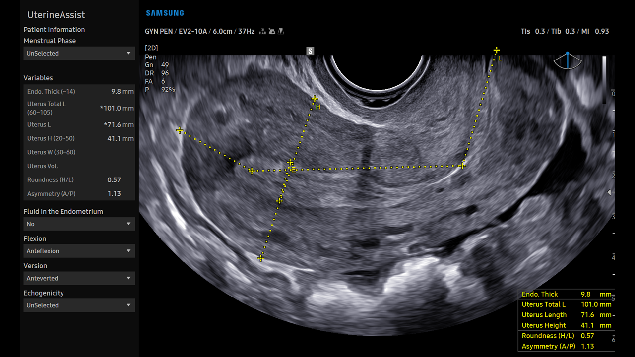 UterineAssist V-Series