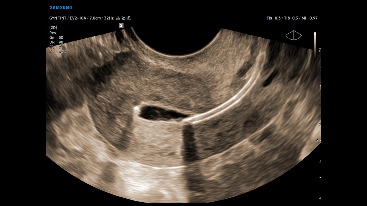 Uterus Imaging