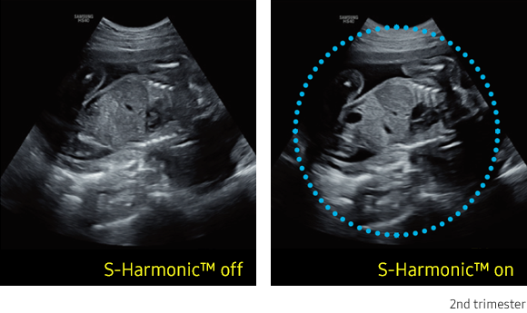 WS-HS40 Comprehensive Imaging Solutions_S-Harmonic On-Off