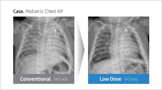 dr-ped-chest-x-ray-r