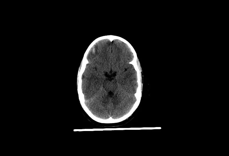 mct-Axial Brain 7 yo-3