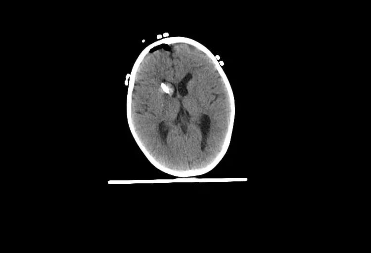 mct-Pediatric 4 yo Brain-4