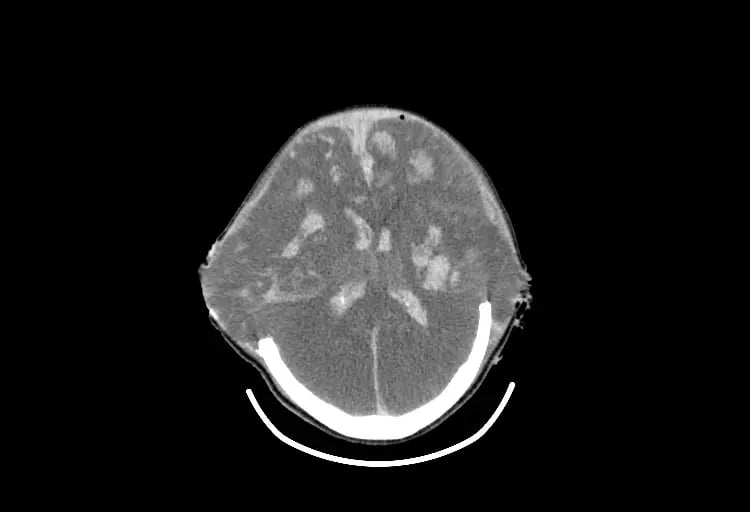 mct-Pediatric Brain