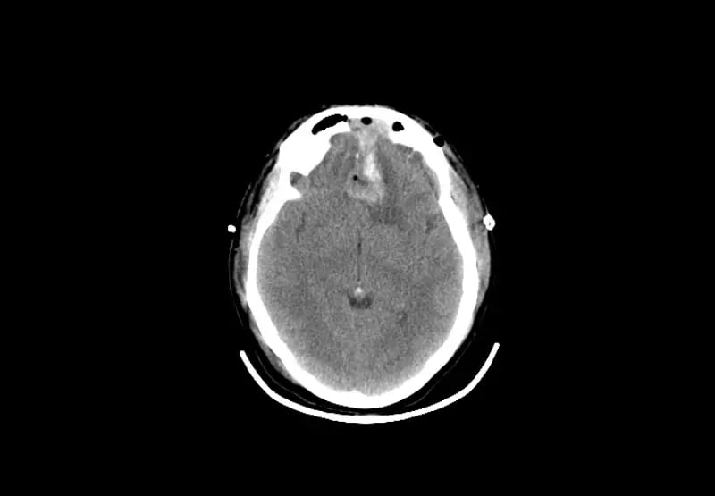 mct-icu-AAdult Brain-1