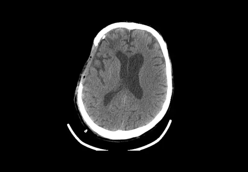 mct-icu-AAdult Post Surgical Craniotomy-2