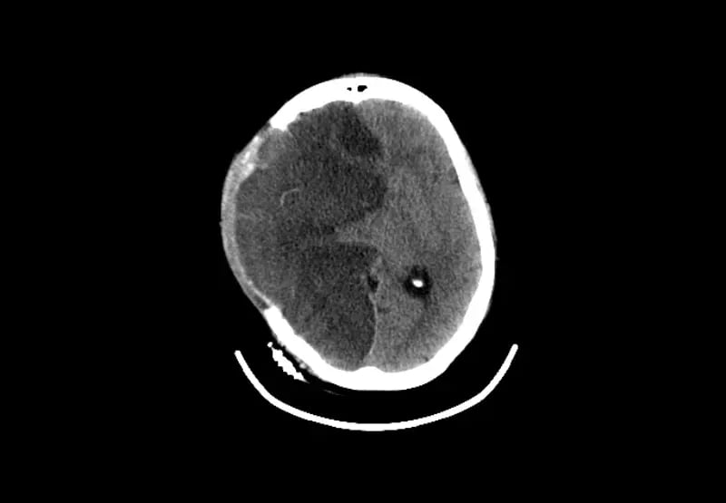 mct-icu-AAxial Brain-2