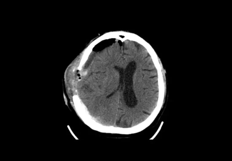 mct-icu-Adult Brain Post Surgery-2