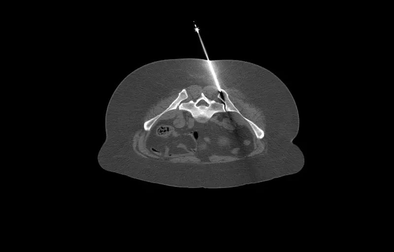 mct-interventional-rad-Left Iliac Wing Biopsy