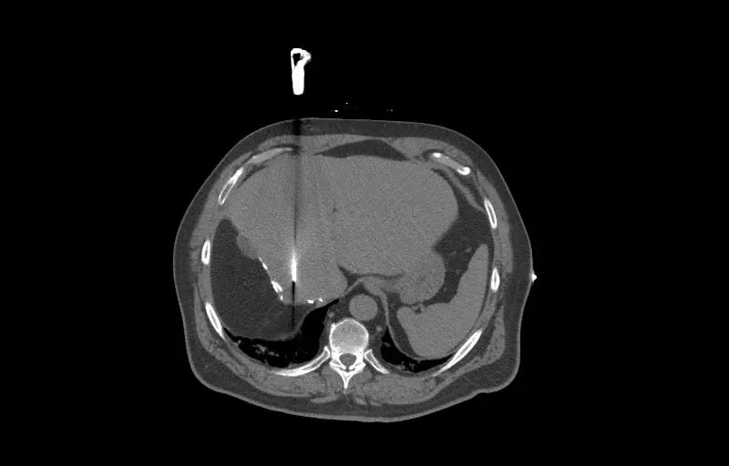 mct-interventional-rad-Liver Ablation
