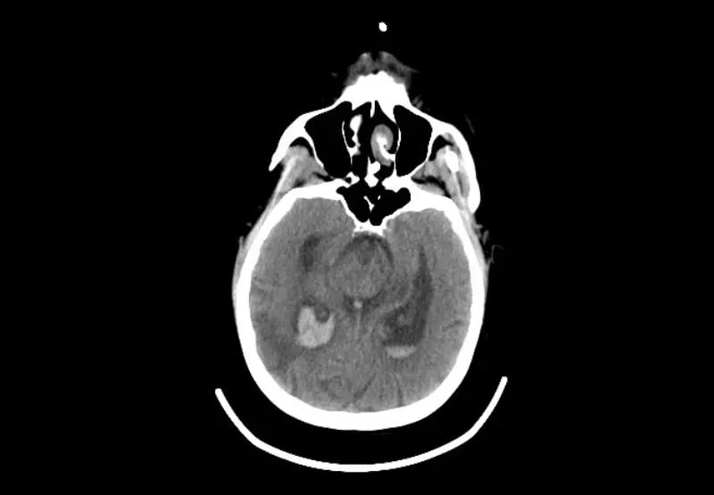 mct-mobile-stroke-Adult Brain 1-1-1