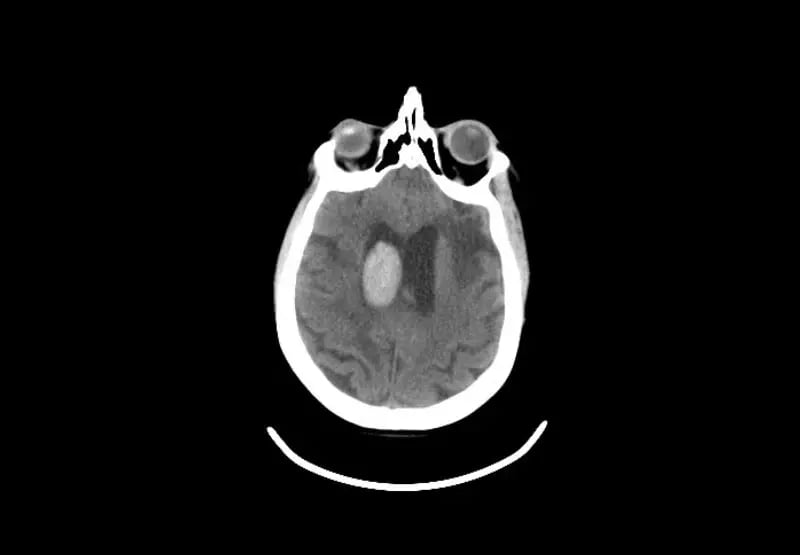 mct-mobile-stroke-Adult Brain 1b-1