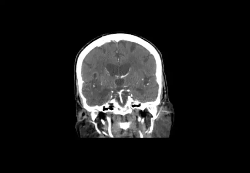 mct-mobile-stroke-Coronal CTA-1