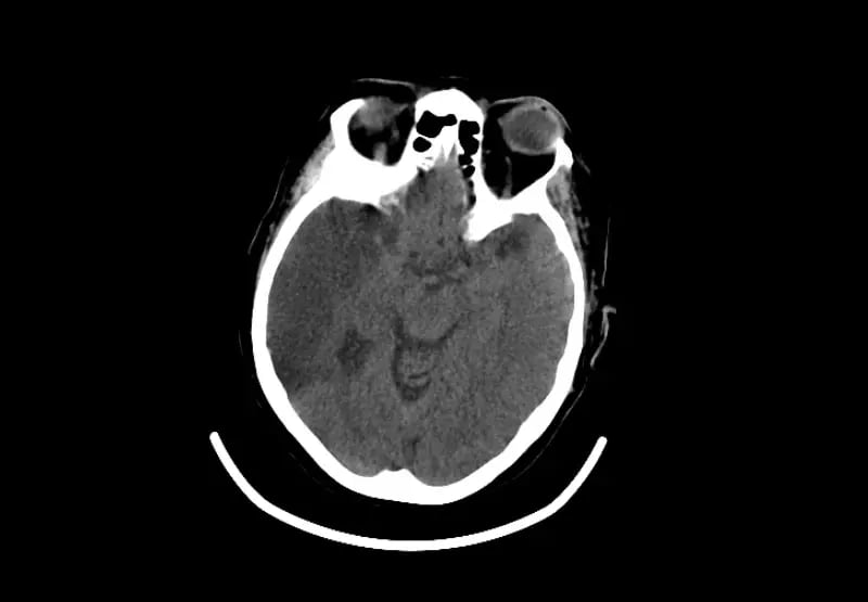 mct-mobile-stroke-Mobile Stroke 1-1