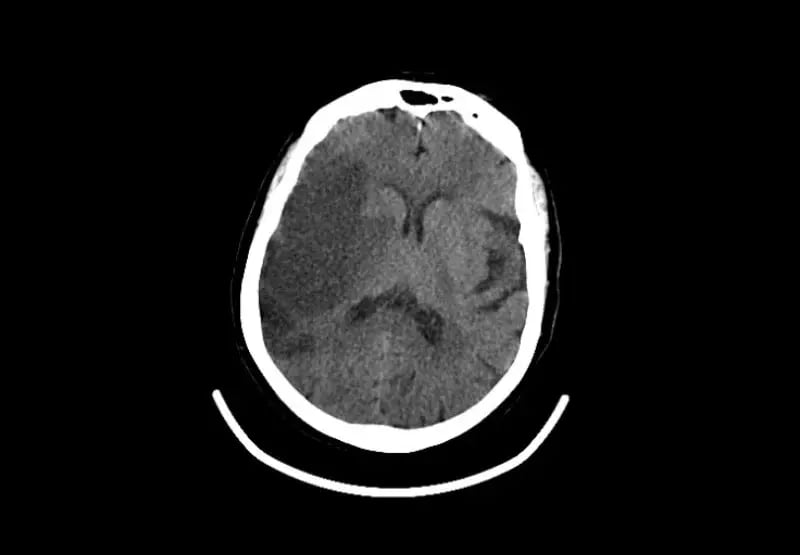 mct-mobile-stroke-Stroke C-1