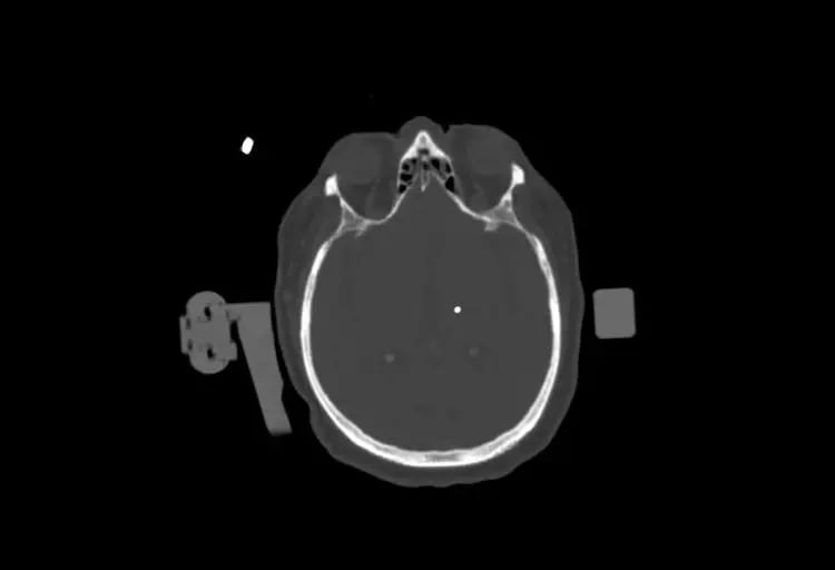 omnitom-elite-1.25mm Deep Brain Stimulation  Bone Window 1 Electrode-2