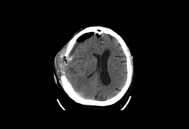 omnitom-elite-Adult Brain Post Surgery-1