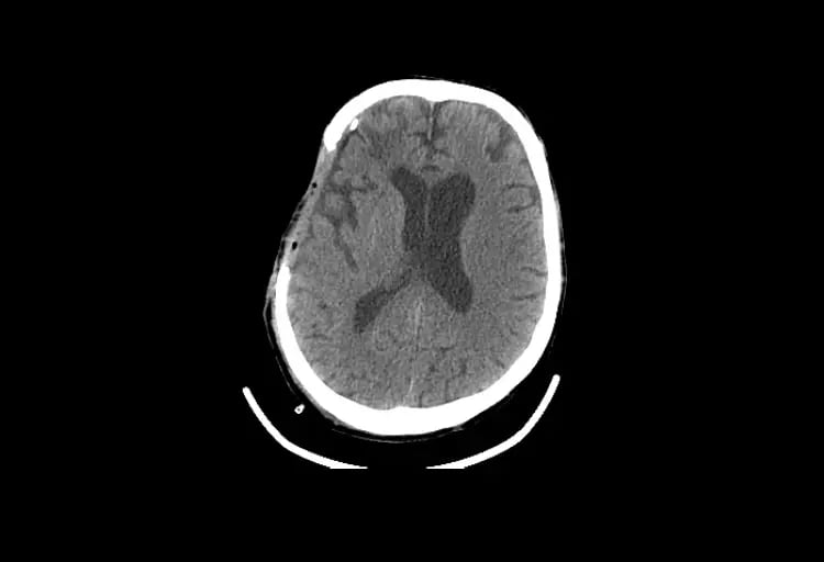 omnitom-elite-Adult Post Surgical Craniotomy-1