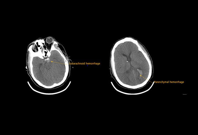 omnitom-elite-pcd-hemorrhage