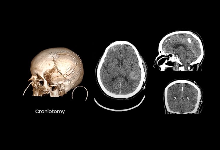 omnitom-elite-pcd-icu-hemorrhage