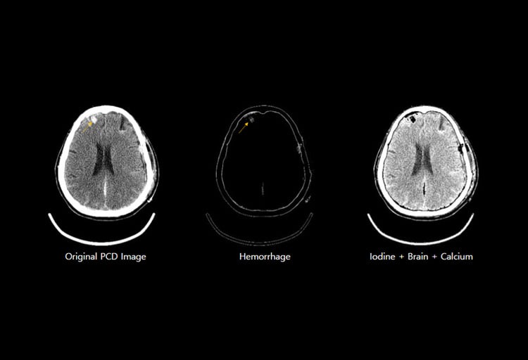 omnitom-elite-pcd-intracerebral-hemorrhage