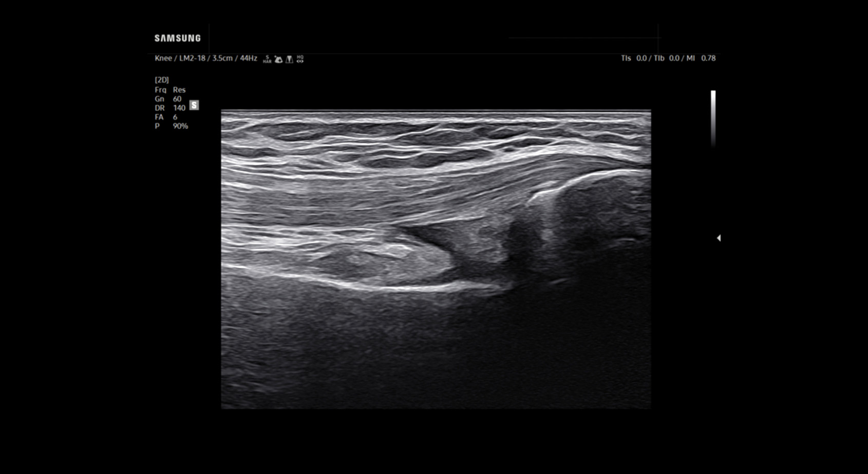 r20-carousel-Suprapatellar