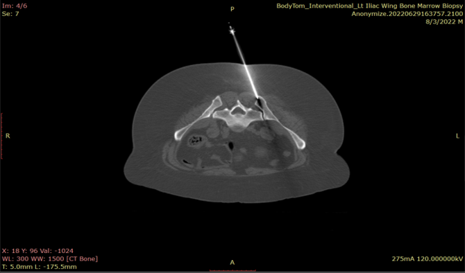 rescan to advance needle