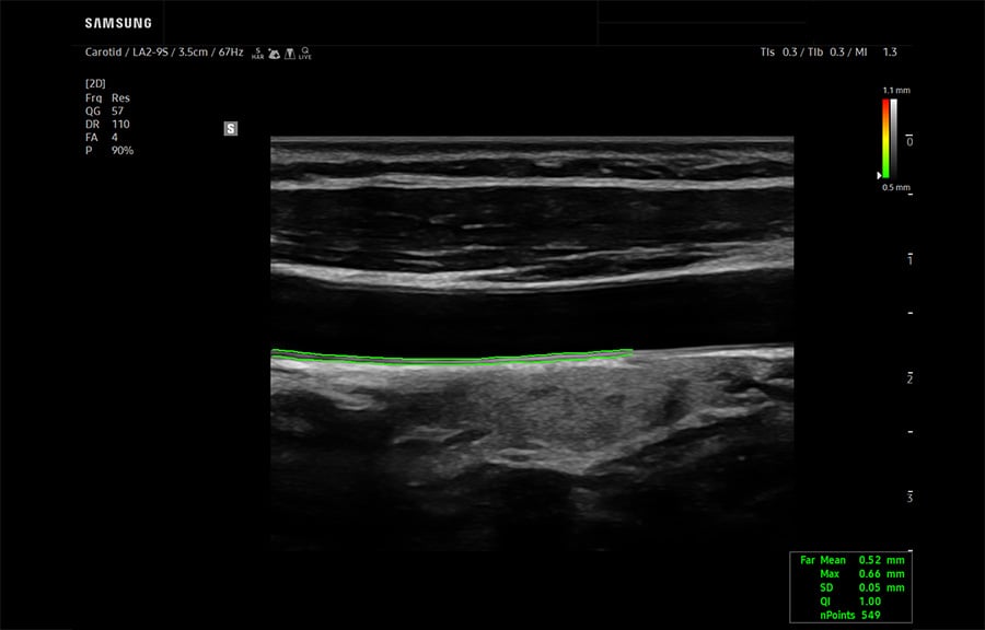samsung-AutoIMT-carotid